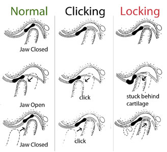 TMJ Disorders