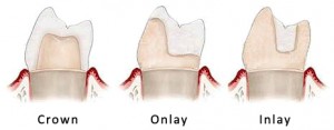 Inlay and Onlay